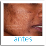 acne, que hace un dermatologo, tratamientos para acne, cicatrices, imagenes del acne, eliminar las cicatrices,, quitar manchas de la piel, manchas de la cara